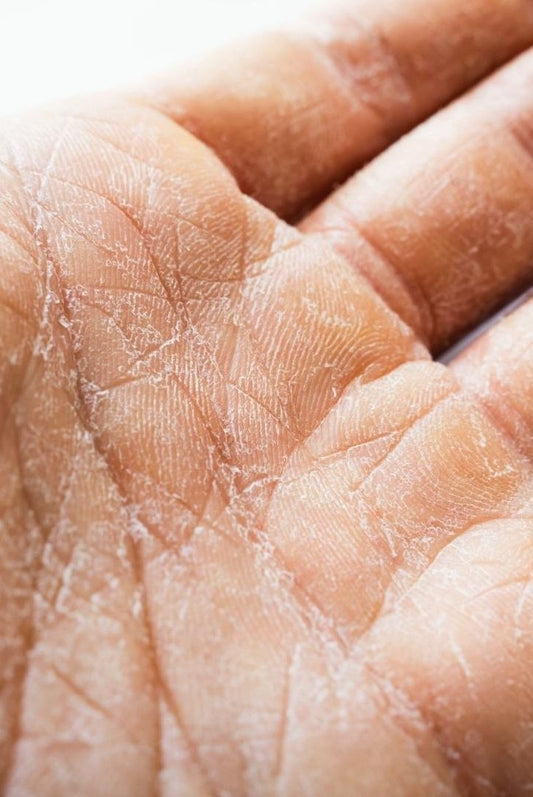 dry skin from washing hands too much causing hands keep cracking and my knuckles are dry